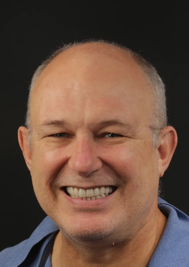 Facetas de cerâmica