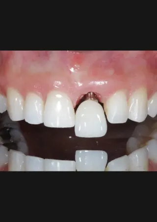 Implante dental
