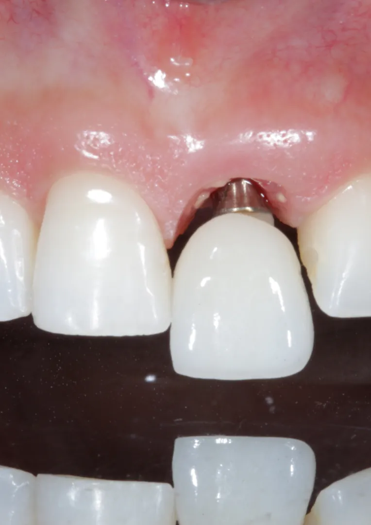 Implante Dentário