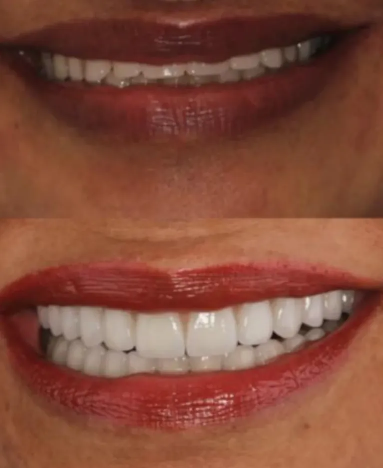 Reabilitação oral total com coroas cerâmicas (protocolo)