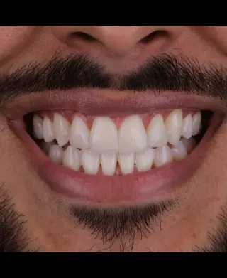 Clareamento Dental